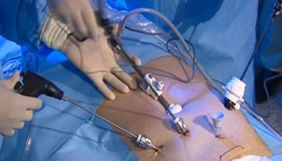 Prostatectomy