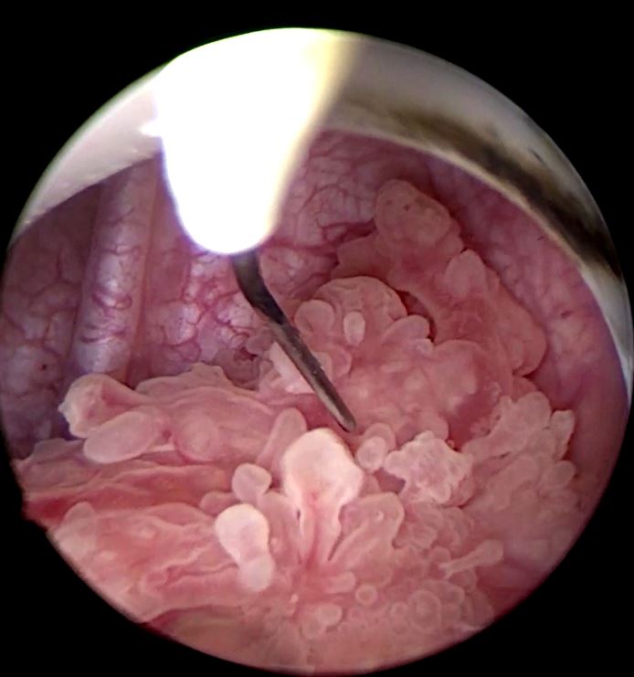 Transurethral resection of bladder tumors