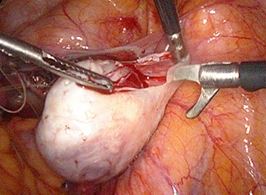 Cystectomy