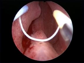 BPH: Resection