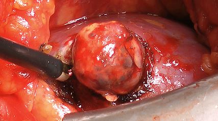 Nephrectomy
